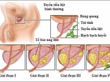 Ung thư tuyến tiền liệt xảy ra khi nào?